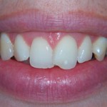 Conventional Porcelain Veneers Before