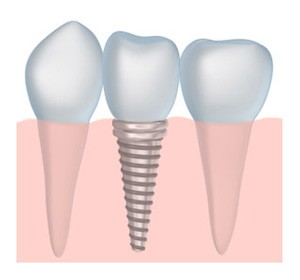 Replacing missing teeth with dental implants